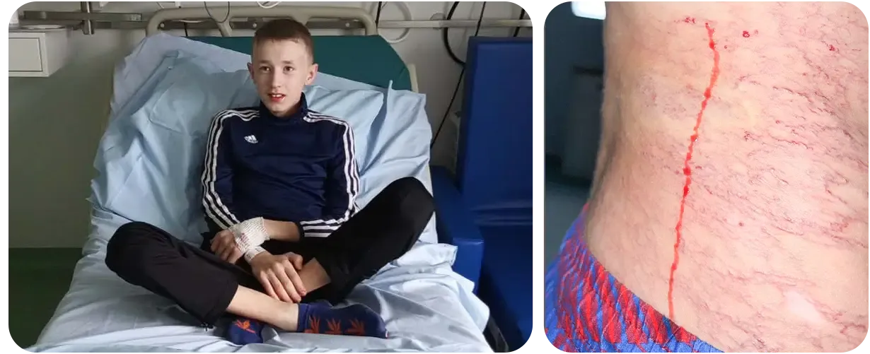 Rozległa malformacja żylna❗Trzynastoletni Ksawery znów staje do walki❗