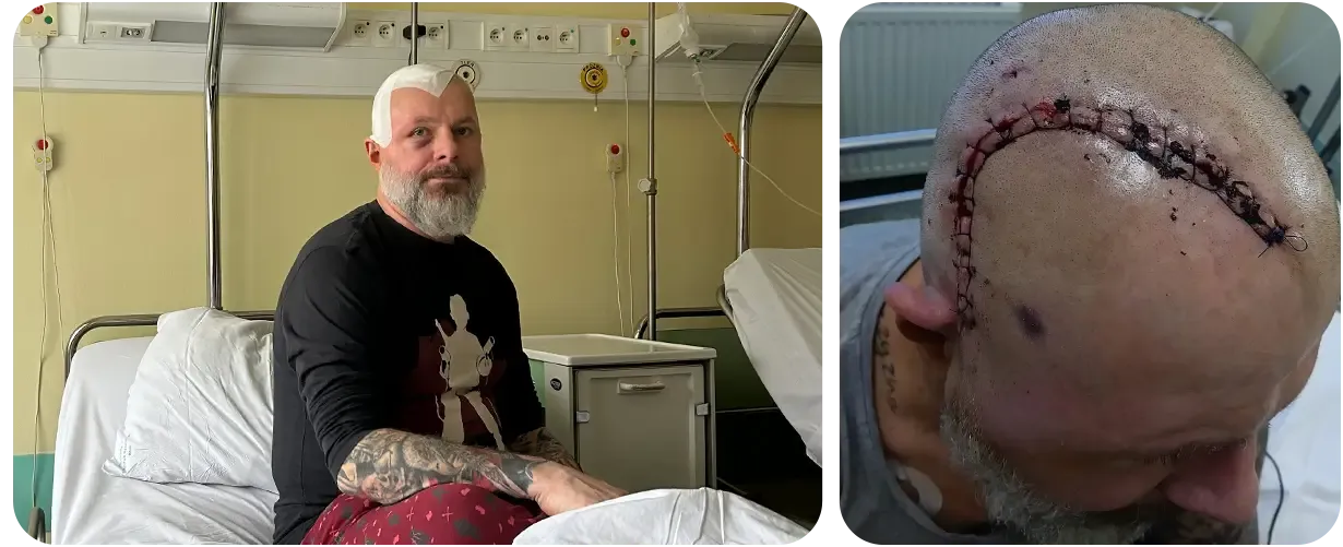 Glejak wielopostaciowy mózgu❗Paweł rozpoczął najtrudniejszą walkę swojego życia❗